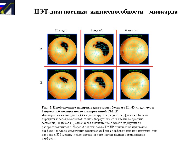ПЭТ-диагностика  жизнеспособности   миокарда